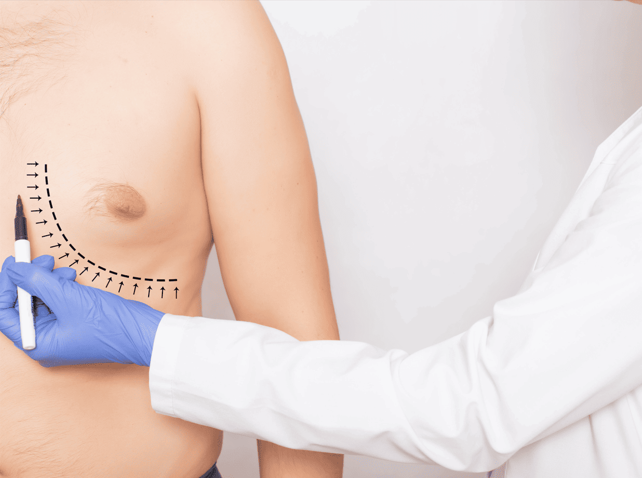 How Long Does It Take For Gynecomastia To Go Away?